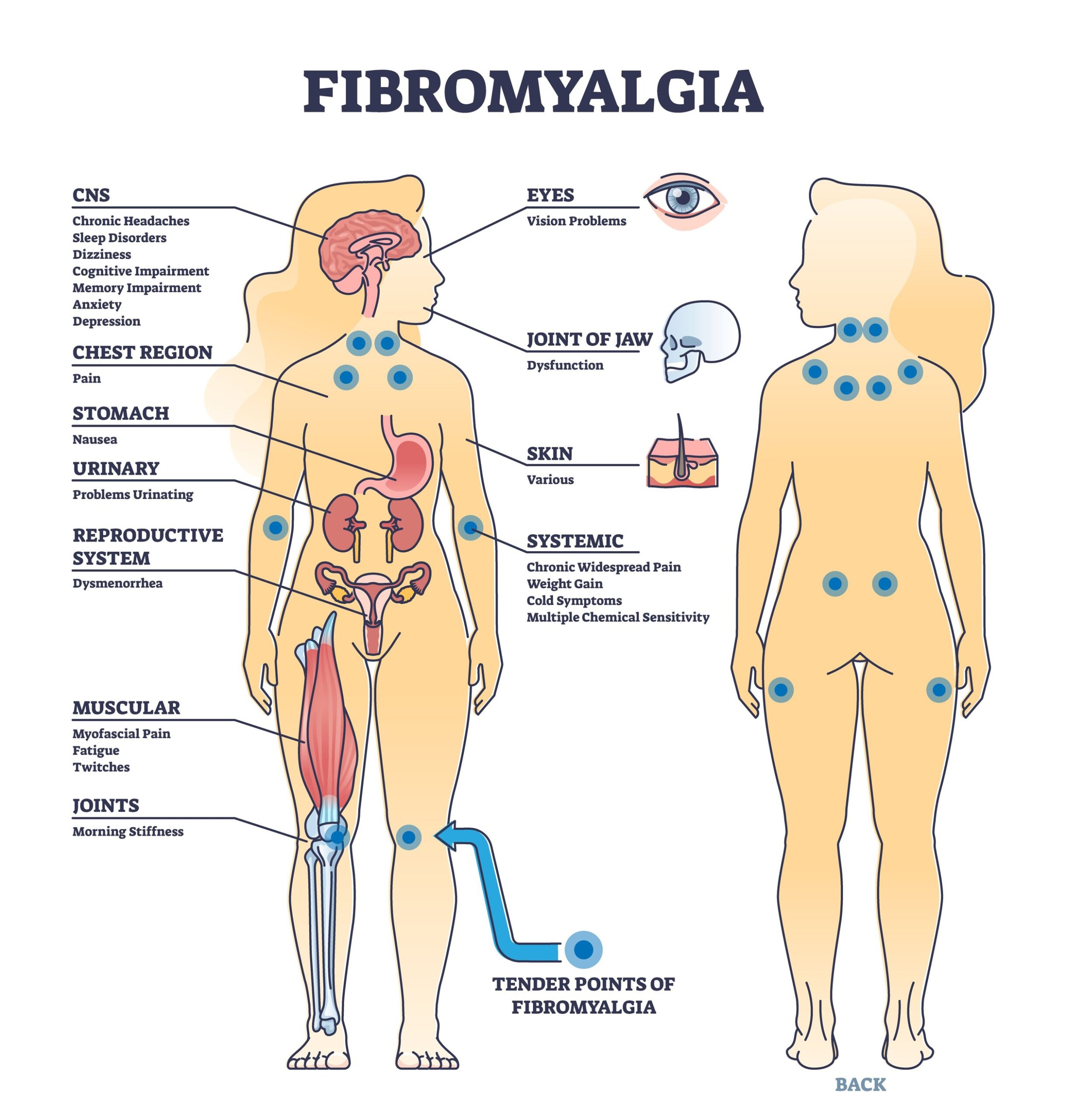 Fibromyalgiasymptoms